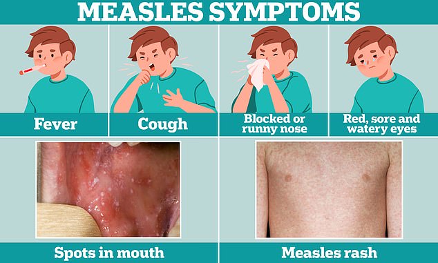 Cold-like symptoms such as fever, cough, and a runny or stuffy nose are often the first sign of measles. A few days later, some people develop small white spots on the inside of their cheeks and the back of their lips. The characteristic measles rash also appears, usually starting on the face and behind the ears before spreading to the rest of the body.