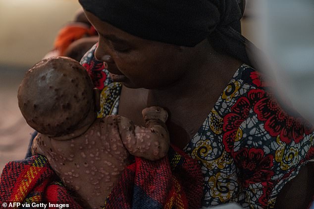 A woman cares for her baby who is suffering from a severe form of MPOX in eastern Democratic Republic of Congo