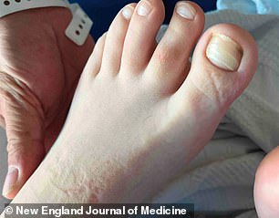 The image above shows the horizontal ridges on the toenails of a 12-year-old American boy, as they had become brittle due to multiple deficiencies of vital nutrients.