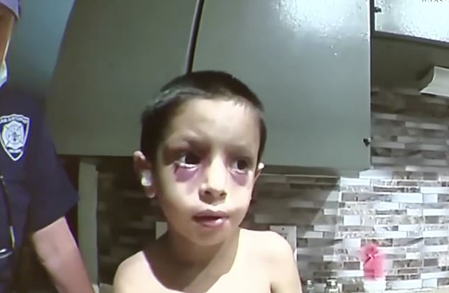 During a welfare check (pictured), Benjamín was seen with black eyes and extremely thin.