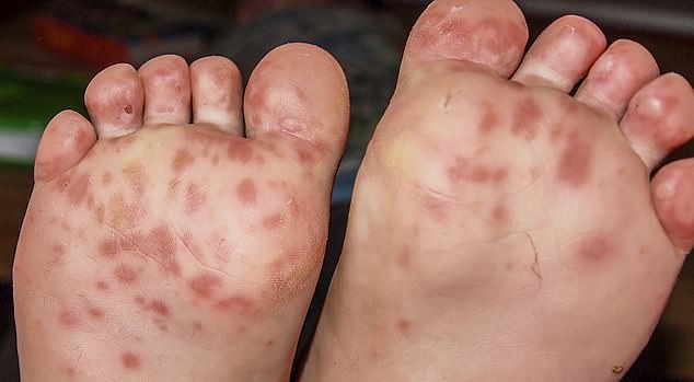 Hand, foot, and mouth disease causes a rash and painful sores on the hands, feet, and inside of the mouth. Sores may also appear on the buttocks, and although the rash is not itchy, it can be very painful.