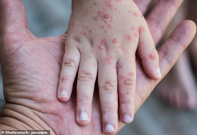 Hand, foot and mouth disease is most common in children under seven years of age. The virus has no cure and typically runs its course in about a week.