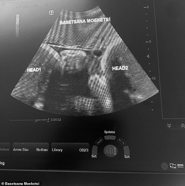 The 36-week scan (pictured) shows two babies for the first time, just a week before Basetsana gave birth.