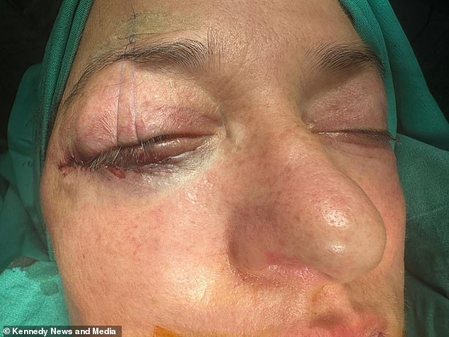 The bar manager was forced to return to Türkiye for revision surgery but claims his lower eyelids drooped again within days.