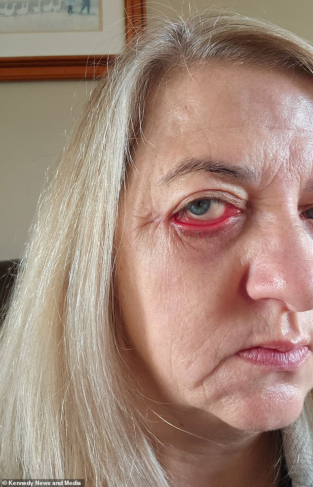 The 51-year-old said she was left low on self-esteem when the surgery left her with droopy eyelids like a basset hound.