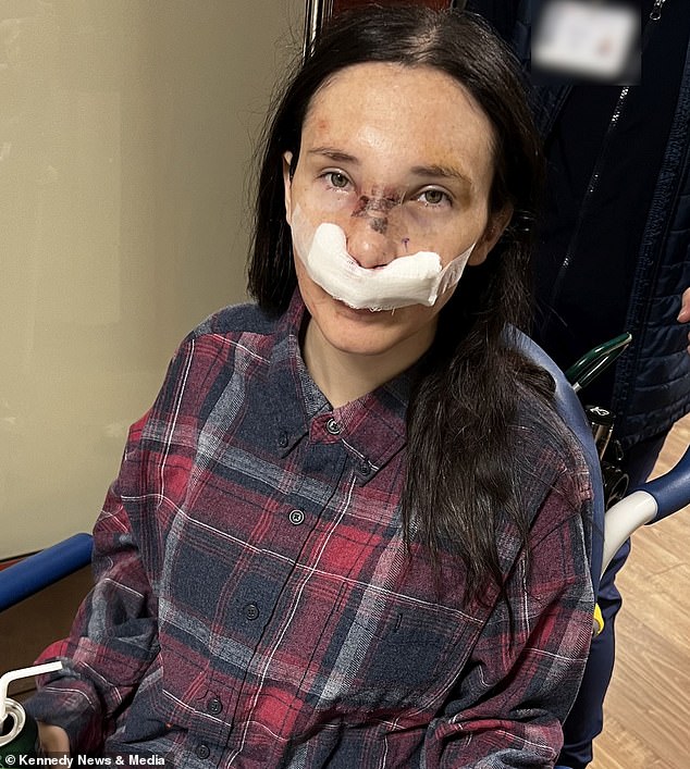 Since undergoing surgery to repair her nose, Ms. Mortensen has undergone two rounds of fillers to restore the shape of her nose.