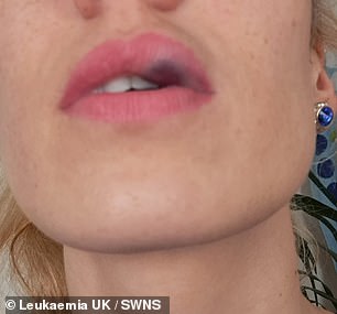 A filler injection last April immediately caused her lip to swell, leaving severe bruising. Unusual bruising, unusual bleeding, fatigue, and repeated infections are telltale signs of cancer.