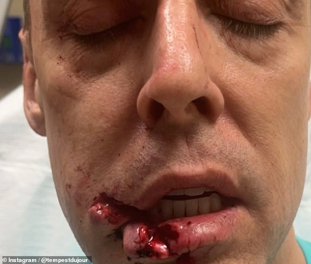 The shocking photos shared on the social media platform also show the season 7 contestant's bleeding cut lip and stitches.