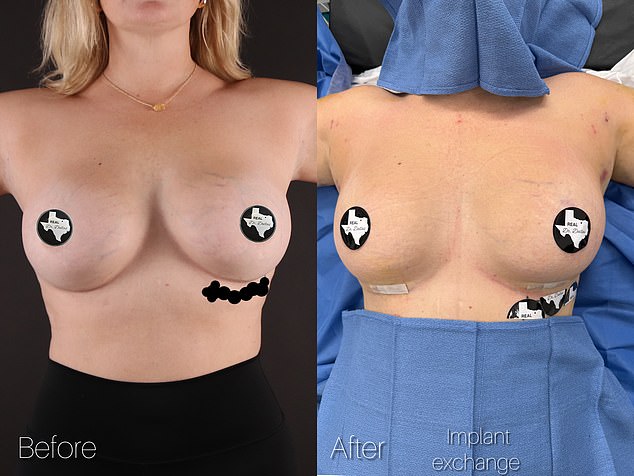 The 38-year-old woman had her breast implants redone to a smaller size after she was unhappy with the original size of her breast.