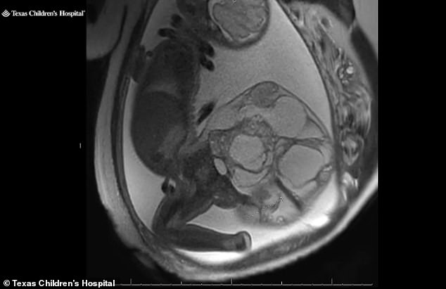 The image above shows Adalida's ultrasound, where you can see the tumor, called sacrococcygeal teratoma.