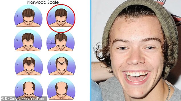 In 2012, at the age of 18, Harry's hairline was beginning to recede slightly, placing him at stage 2 on the Norwood scale.