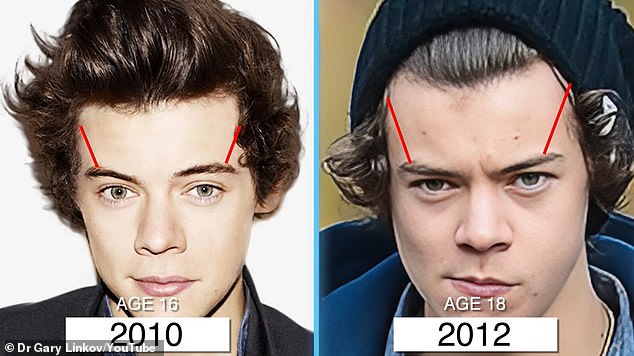 Compared to just two years earlier, in 2012, Harry's hairline was receding from his eyebrows.