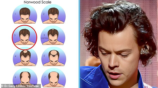 In 2019, Dr. Linkov said that Harry's hair recession had progressed to stage 3 on the Norwood Hair Loss Scale.