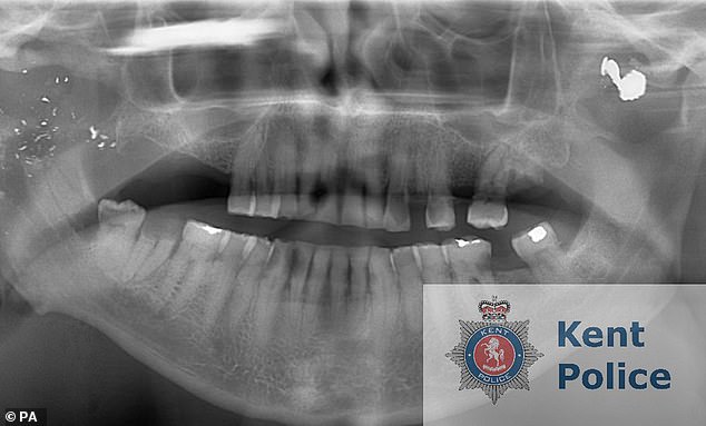 The father of seven, who suffers from terminal brain cancer, still has the bullet scar and second-degree burns that remind him of the incidents. Pictured: An x-ray of Raymond Weatherall's jaw, with a bullet visible.