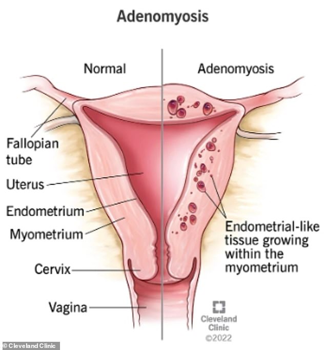 It is not known exactly why adenomyosis occurs. But the NHS points out that it is 