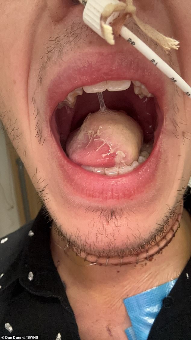 Doctors initially hoped to remove only part of his tongue, but after finding a second tumor they were forced to remove half.