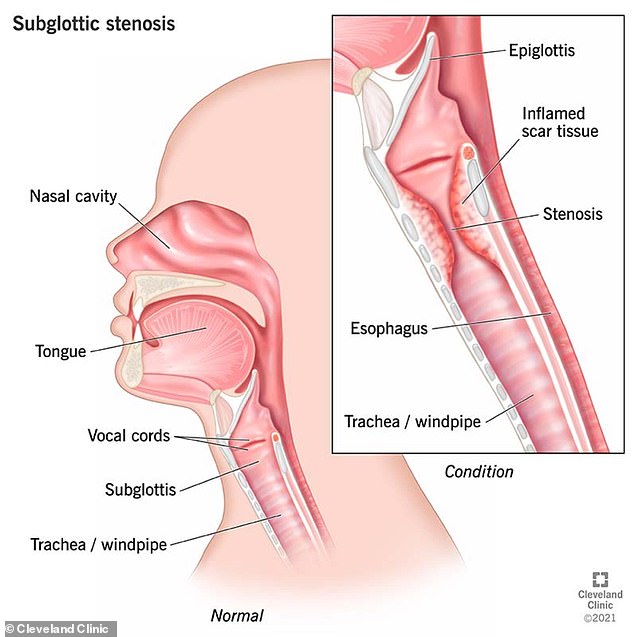 The graph above from the Cleveland Clinic shows a normal airway (main) and then one with subglottic stenosis (inset).