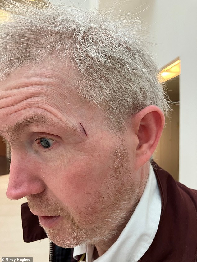 He was traveling to Glasgow's Partick station on Monday morning to collect betting winnings from the first night of eviction of the new Big Brother housemates (injury pictured).