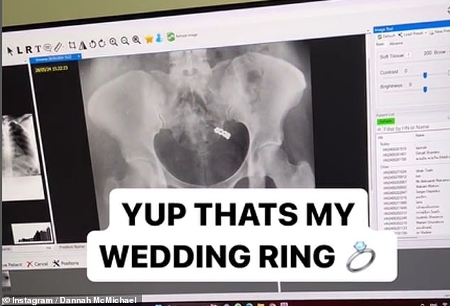 McMichael shared a video of the moment doctors found her ring, which she humorously captioned: 