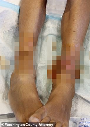 A boy seen with infected cuts on his legs