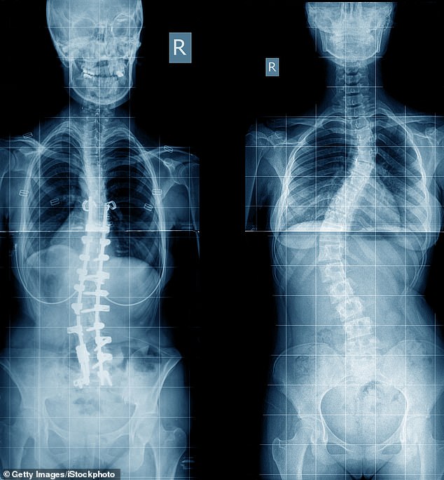 About 24 percent of people ages 16 to 26 have called in sick with back and neck pain in the past 12 months (file shows scoliosis in one patient, right)