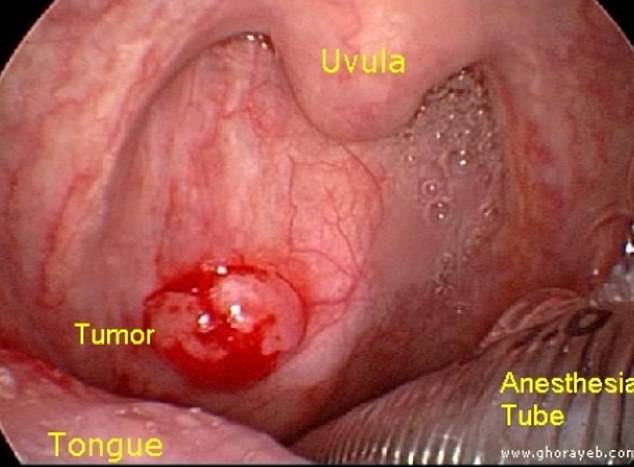 HPV causes about 60 percent of oropharyngeal cancers. Photo courtesy of medbullets.com