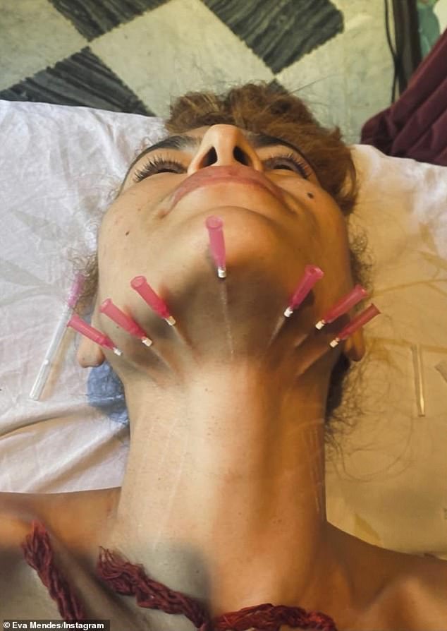 In 2020, she shared photos of herself undergoing a procedure called Mono-threading, which involves inserting threads with needles at various points to help lift and tighten the skin.