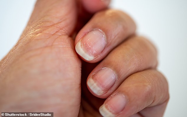 Brittle nails could be a sign of iron and protein deficiency, Dr. Sethi said in his TikTok video.