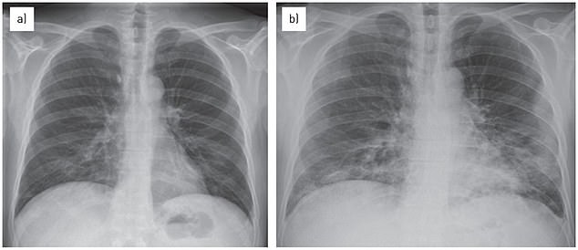 White masses in the lungs represent fluid-filled air sacs that infectious disease experts say indicate mycoplasma pneumonia.