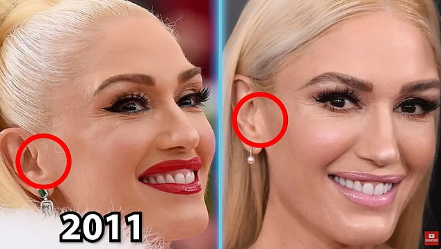 He also shared these photos of Gwen to suggest she may have had a facelift. The surgery involves making incisions around the ears and tightening them, which can cause changes in the appearance of the earlobe and tragus, the tongue-shaped projection in the outer ear (circled).