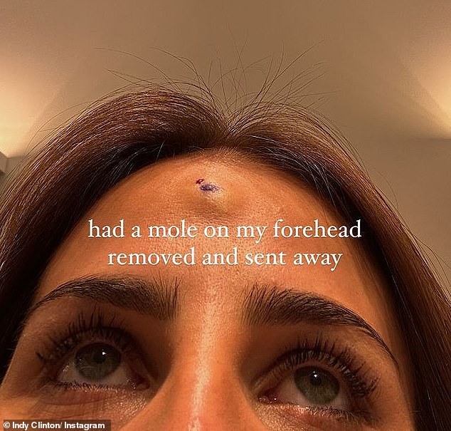 The TikTok superstar, 27, took to Instagram on Tuesday to share a graphic image of her forehead after having a mole cut off.