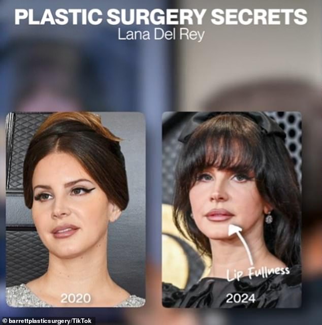 Dr. Barrett believes there is 'a little bit of filler' showing in her lips and cheeks based on photos of the singer at the 2020 and 2024 Grammy Awards.