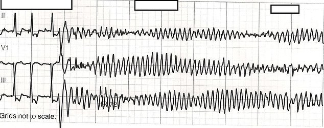 The woman's heart rate was disorganized and at times very low and other seconds very high. The photo above is an example of an irregular heartbeat.