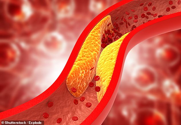 Ischemic heart disease, also known as coronary heart disease or coronary artery disease, occurs when blockages in blood vessels cause reduced blood flow to the heart. This may be due to plaque buildup, a blood clot, or a narrowing of blood vessels.