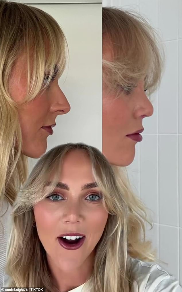 Annie recently shared a video on TikTok showing before and after photos of her nose after undergoing the cosmetic procedure.