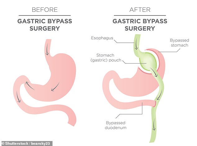 Bariatric surgery, commonly known as weight loss surgery, consists of a variety of potential procedures including gastric sleeves, gastric bypass, and gastric banding. This illustrated example shows a gastric bypass.