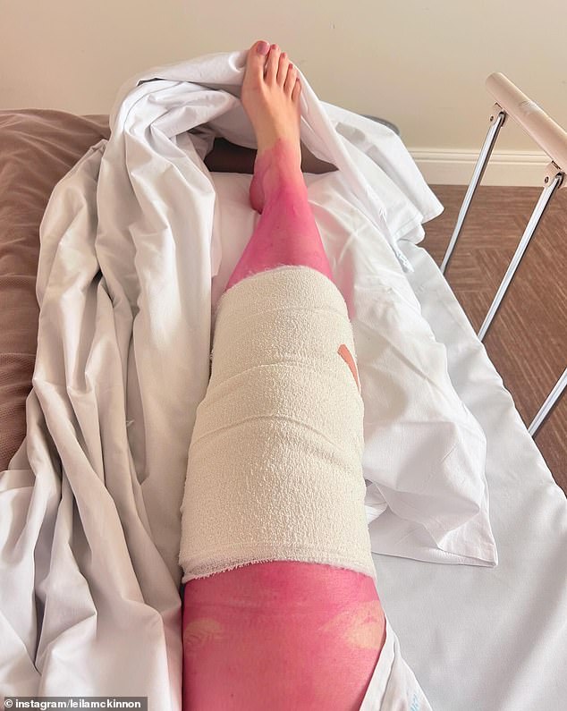 Leila shared an image of her leg, which was a vibrant pink color. He may be as high as a kite right now after another delicious knee operation. But something alarming seems to have happened... is my leg pink? By the way, the surgical team played me some brilliant Chappell Roan tunes