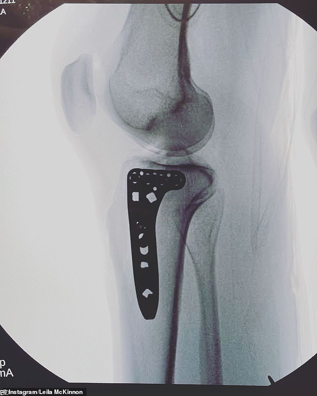 In her caption at the time, Leila explained that she had to stick a pin in her broken knee while sharing images of her x-rays.