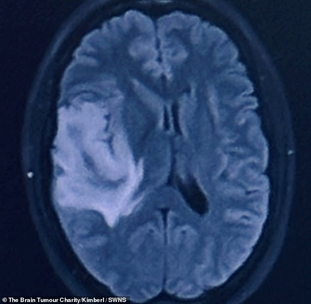 Since then, he has also battled sepsis, which delayed the start of treatment. Pictured is Ms Baggley's brain scan showing the tumor (light blue)