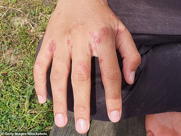 Health officials warn the public to watch for symptoms of scabies, which can appear as a red rash between the fingers.