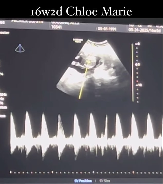 The above shows the fetus, which she named Chloe, in the womb.