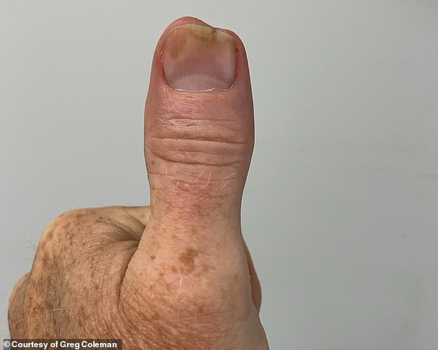 The bacterial infection entered Mr Coleman's thumb bone, so the tip had to be removed.