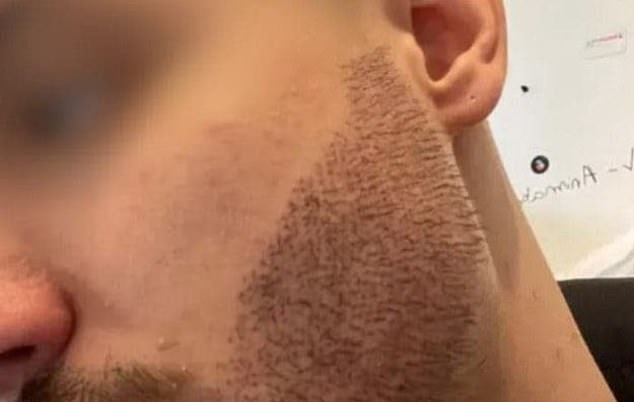 The treatment left the Frenchman's beard with an irregular shape and growing at an unnatural angle.