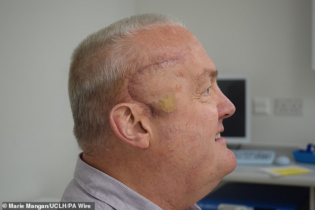 The 62-year-old engineer from Luton is the first patient to take part in the trial and has seen his tumor halve in a matter of weeks. For the procedure, surgeons removed as much of the tumor as possible before implanting a small medical device called an Ommaya reservoir under the scalp, which connects to the tumor through a small tube.