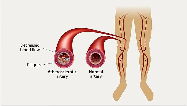 Cholesterol can build up in small blood vessels in the legs, causing pain when walking, numbness, hair loss, shiny skin and sores, all signs of PAD. Detecting and diagnosing PAD can help someone prevent heart disease, stroke or amputation in the future, Dr. Pollak said.