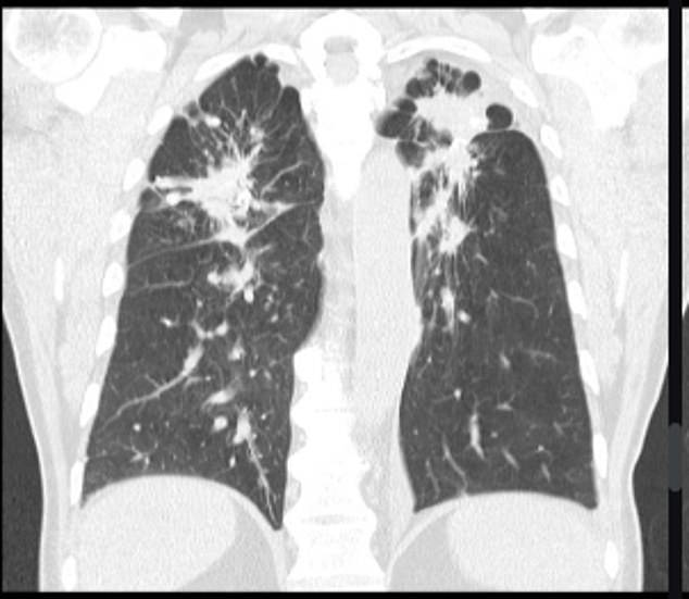 Silicosis appears on a CT scan as small white nodules scattered throughout the lungs. Scan courtesy of radiopaedia.org