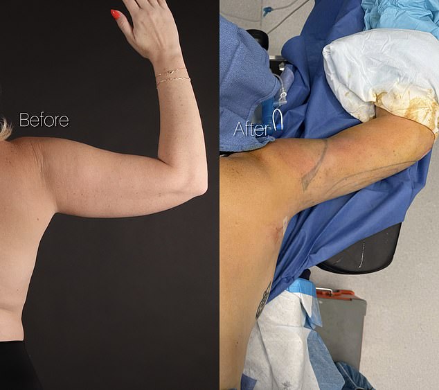 The mother of two also had liposuction on her arms to slim them down.