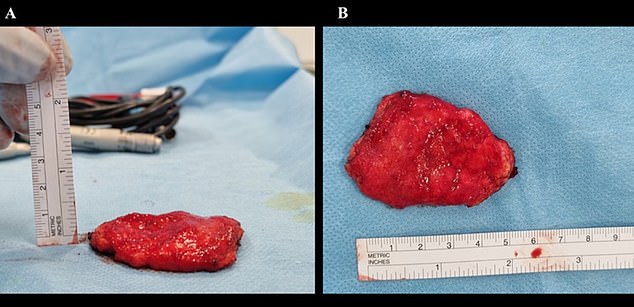 MRI scans performed at Copenhagen University Hospital found that the lump measured 13 inches (33 cm) and that the skin and tissue around it had thickened.