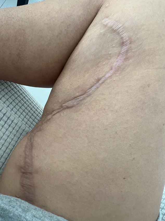 Surgery to remove biopolymers from Mrs. Arias' legs left her with a huge scar. Photo provided by Mrs. Arias