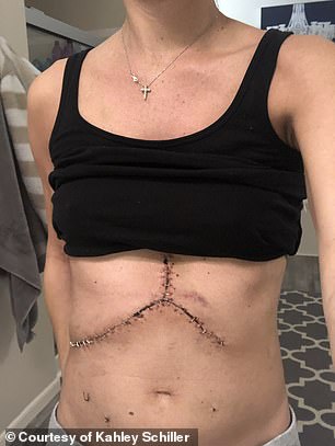 Shown here is Mrs. Schiller's scar from her liver transplant.